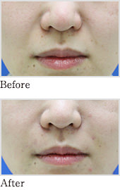脂肪注入のbefore、after