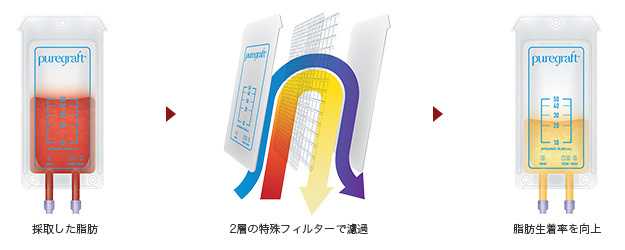 採取した脂肪→2層の特殊フィルターで濾過→脂肪生着率を向上