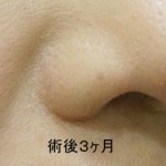 鼻翼縮小術 3Ma