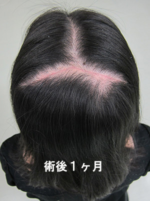 舞妓さん 芸妓さん の おはげ の手術 ヴェリィ美容形成クリニック 京都の美容整形 美容外科 舞妓さん 芸妓さん の おはげ の手術 ヴェリィ美容形成クリニック 京都の美容整形 美容外科