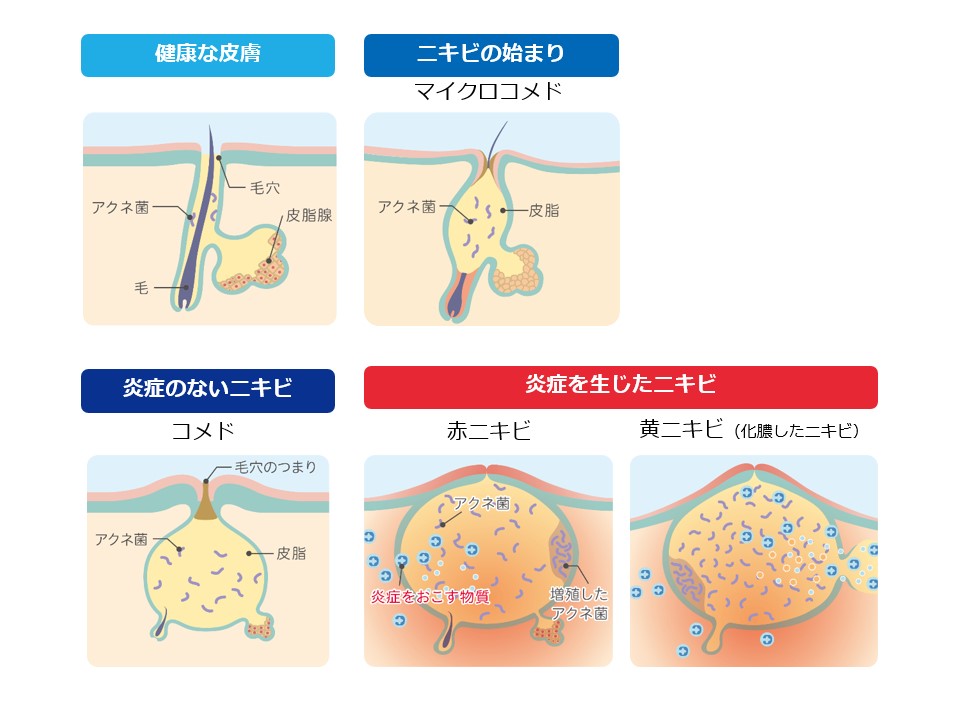 ニキビ特集 画像