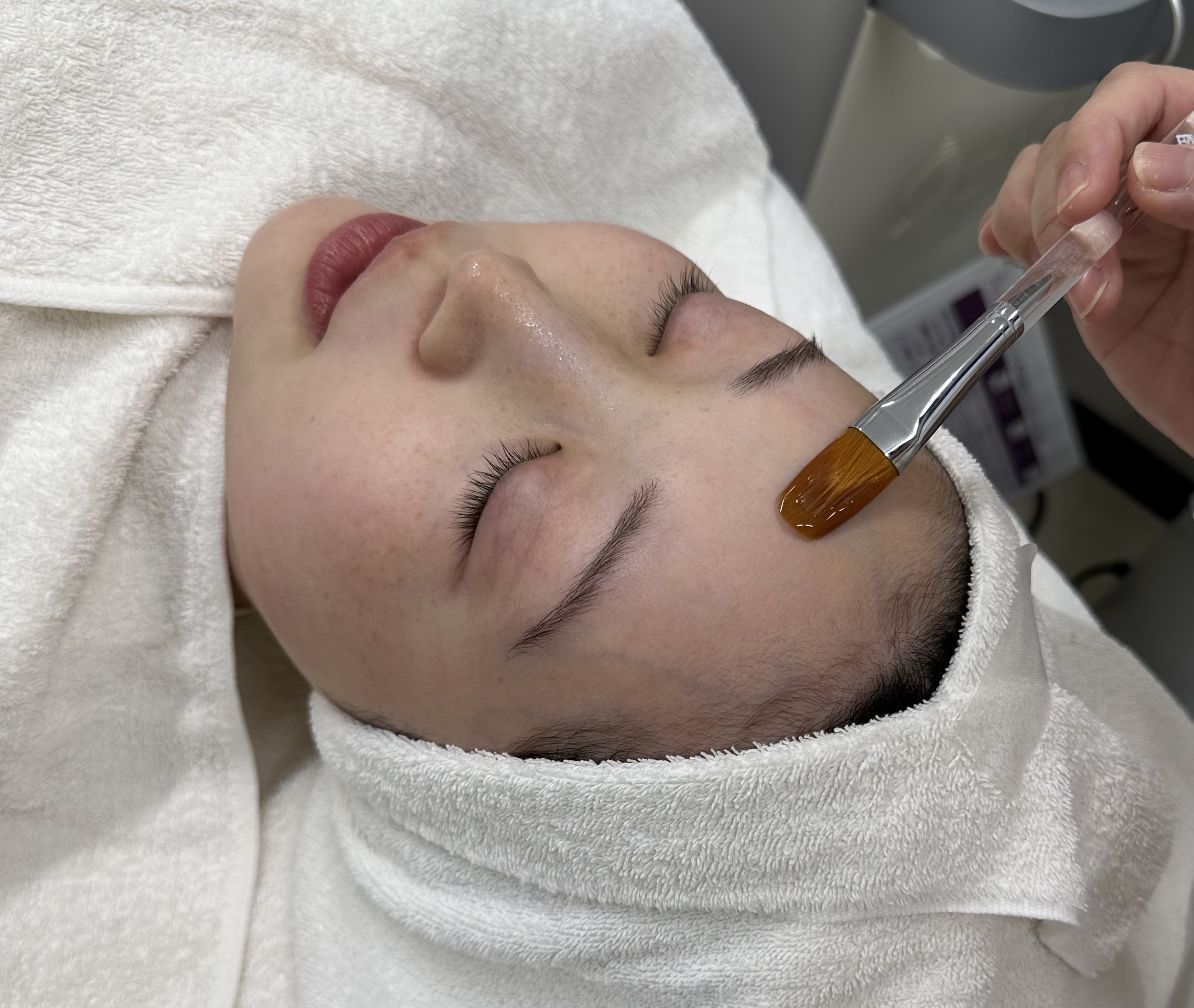 ニキビ特集画像