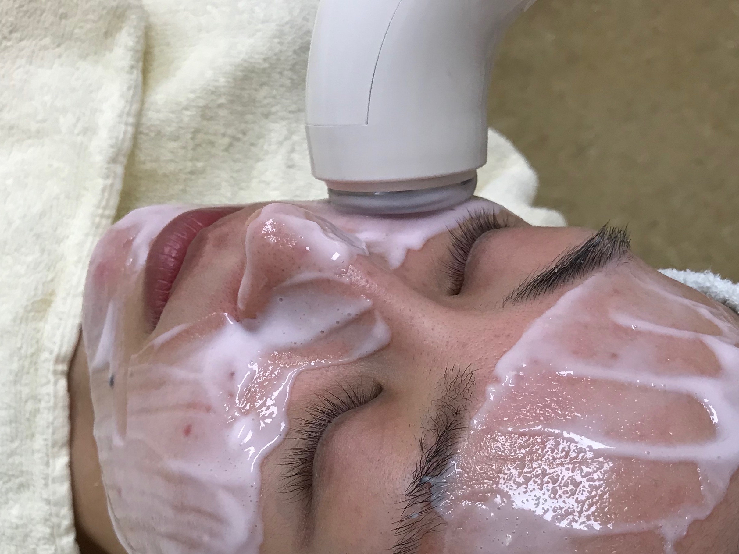 ニキビ特集画像