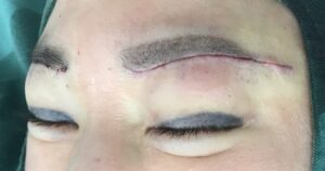 眉下切開の中縫いが終わった状態