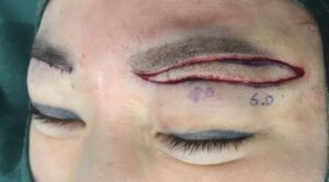 上まぶたのたるみを眉下切開で切除した皮膚